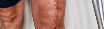 Fisioterapia postoperatoria para rotura de menisco Fisioterapia postoperatoria para rotura de menisco
