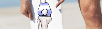 Prevención de la artrosis de rodilla a través de la fisioterapia Prevención de la artrosis de rodilla a través de la fisioterapia