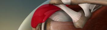 Bursitis del hombro y su tratamiento fisioterapéutico en FisioClinics Palma Bursitis del hombro y su tratamiento fisioterapéutico en FisioClinics Palma