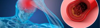 ¿Cómo detectar si estás sufriendo un evento cerebro vascular? - FisioClinics Palma ¿Cómo detectar si estás sufriendo un evento cerebro vascular? - FisioClinics Palma