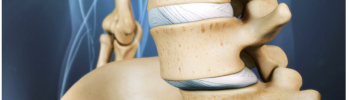 Fisioterapia para la inestabilidad lumbar crónica: prevención y control Fisioterapia para la inestabilidad lumbar crónica: prevención y control