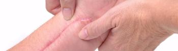 Masaje transverso profundo como tratamiento de las cicatrices en FisioClinics Palma Masaje transverso profundo como tratamiento de las cicatrices en FisioClinics Palma