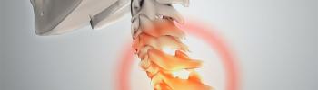 Hernia discal cervical - FisioClinics Palma Hernia discal cervical - FisioClinics Palma