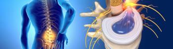 Hernia discal lumbar y fisioterapia - FisioClinics Palma Hernia discal lumbar y fisioterapia - FisioClinics Palma