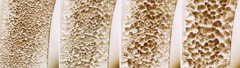 ¿Se puede curar la osteoporosis? - FisioClinics Palma