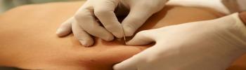 Contracturas musculares, qué son, causas y tratamiento en FisioClinics Palma Contracturas musculares, qué son, causas y tratamiento en FisioClinics Palma