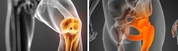 Artrosis de cadera y rodilla ¿En qué consiste? Artrosis de cadera y rodilla ¿En qué consiste?