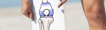 Prevención de la artrosis de rodilla a través de la fisioterapia Prevención de la artrosis de rodilla a través de la fisioterapia