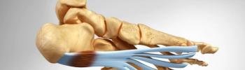 Tipos de Tratamientos para la fascitis plantar- Tratamiento en FisioClinics Palma Tipos de Tratamientos para la fascitis plantar- Tratamiento en FisioClinics Palma