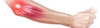 Dolor en el codo: Epicondilitis  Dolor en el codo: Epicondilitis