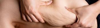 Cómo la fisioterapia ayuda a mejorar la calidad de vida en pacientes con lipedema Cómo la fisioterapia ayuda a mejorar la calidad de vida en pacientes con lipedema