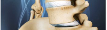 Fisioterapia para la inestabilidad lumbar crónica: prevención y control Fisioterapia para la inestabilidad lumbar crónica: prevención y control