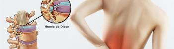 Hernia discal lumbar. Síntomas y causas Hernia discal lumbar. Síntomas y causas