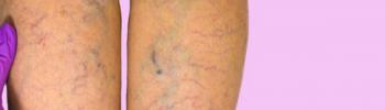 Insuficiencia vascular: que es, causas, síntomas y tratamiento desde la fisioterapia en FisioClinics Palma Insuficiencia vascular: que es, causas, síntomas y tratamiento desde la fisioterapia en FisioClinics Palma