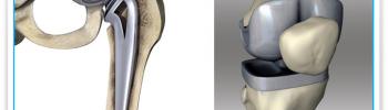 Tratamiento de fisioterapia en prótesis de cadera y rodilla Tratamiento de fisioterapia en prótesis de cadera y rodilla