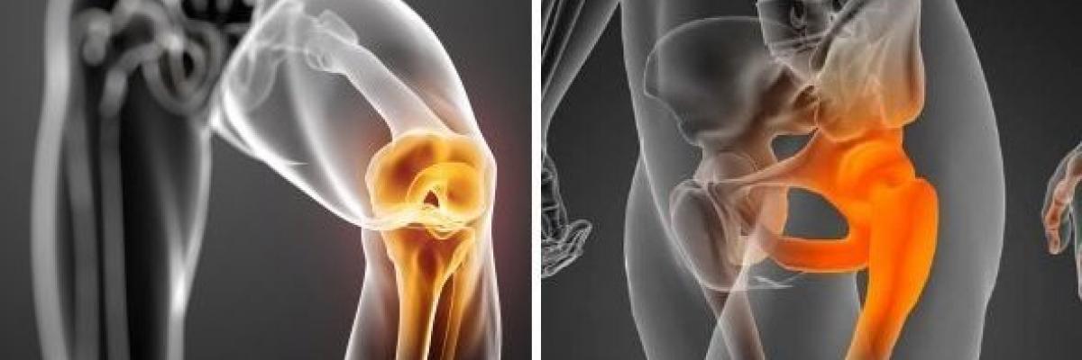 Artrosis de cadera y rodilla ¿En qué consiste?
