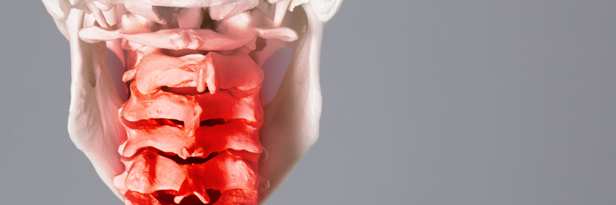 Fortalecimiento muscular para prevenir la progresión de la artrosis cervical