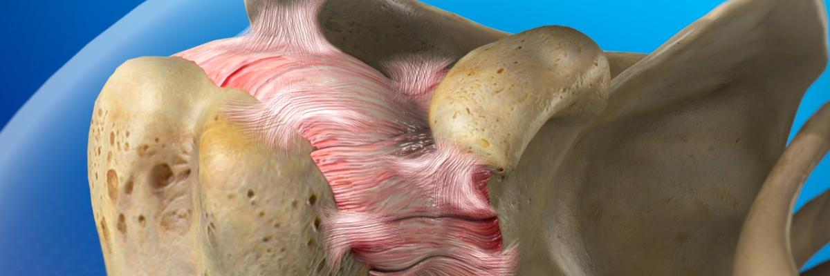 capsulitis adhesiva del hombro