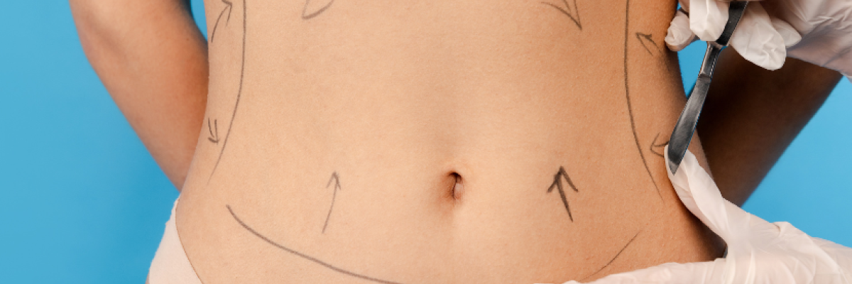 Recuperación tras liposucción: qué hacer para disminuir edema y fibrosis