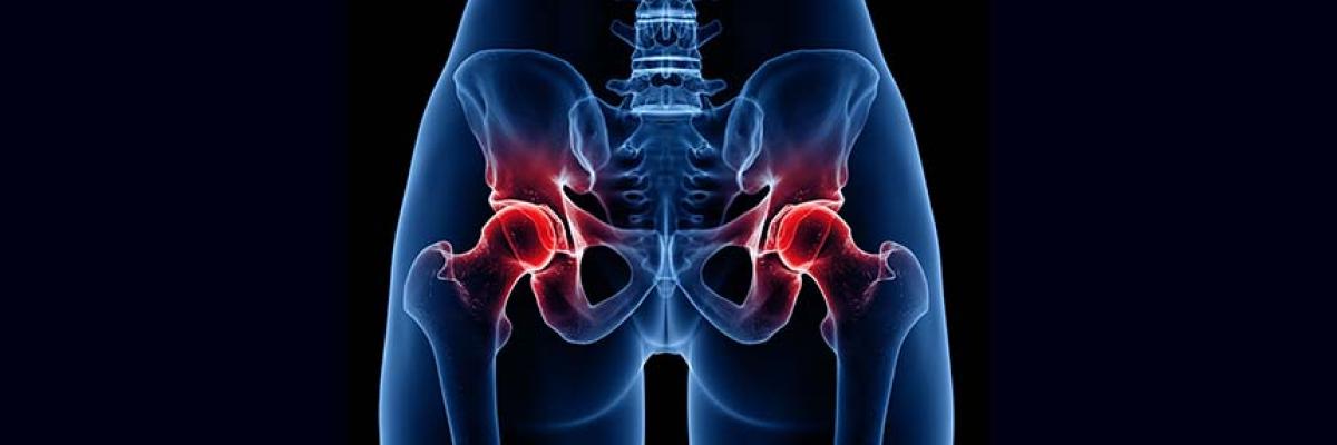 Cómo frenar el avance de la artrosis de cadera