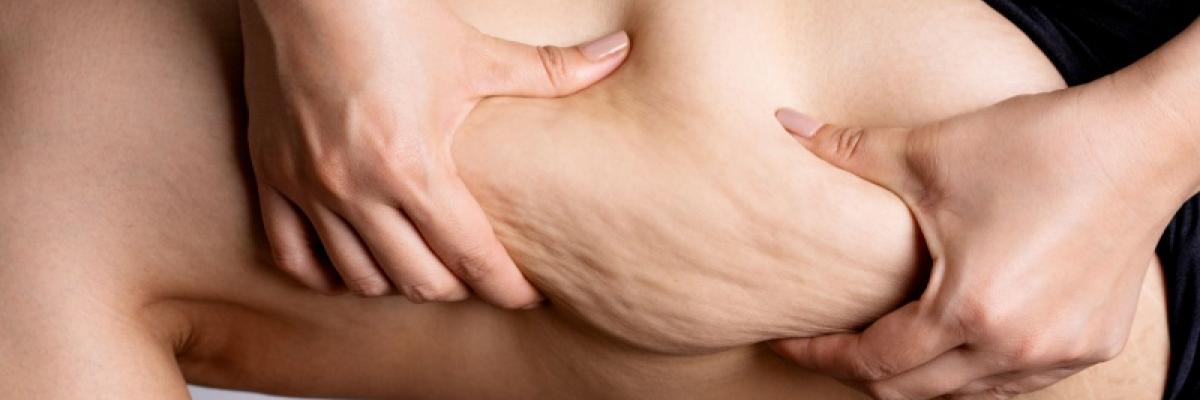 Cómo la fisioterapia ayuda a mejorar la calidad de vida en pacientes con lipedema