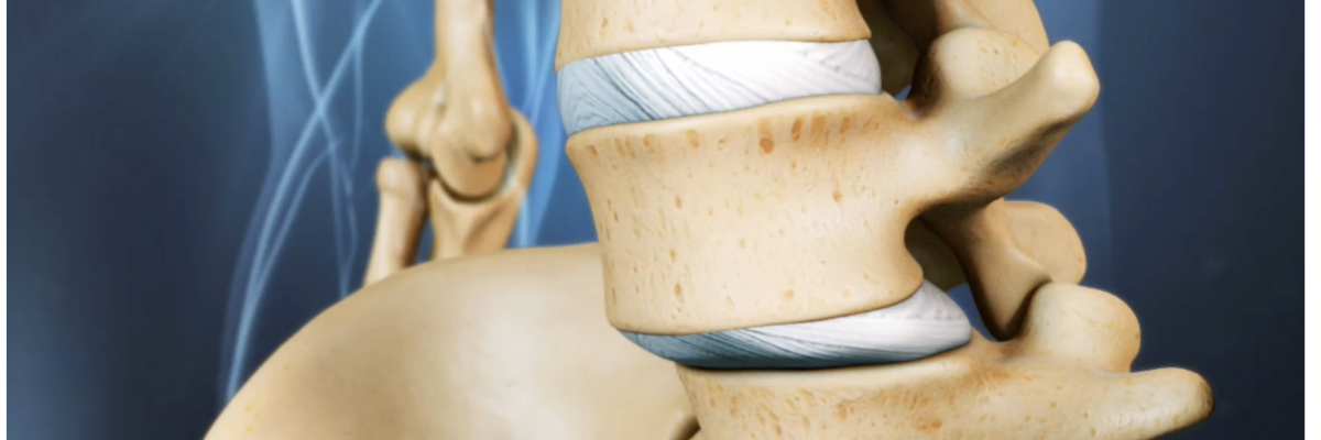 Fisioterapia para la inestabilidad lumbar crónica: prevención y control