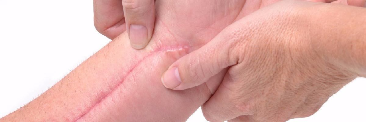 Masaje transverso profundo como tratamiento de las cicatrices en FisioClinics Palma