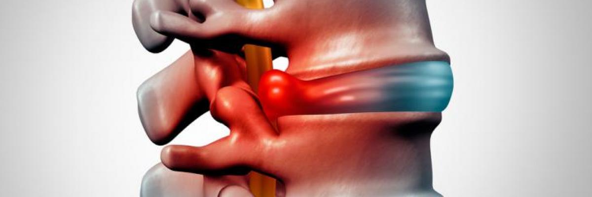 ¿Cuáles son los síntomas de una Hernia discal?