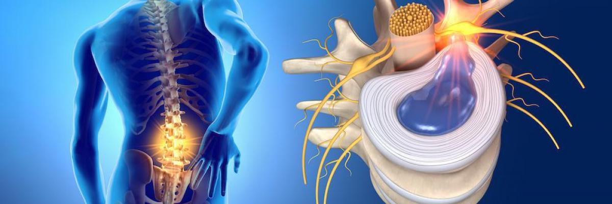 Hernia discal lumbar y fisioterapia - FisioClinics Palma