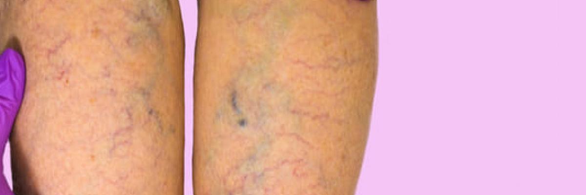 Insuficiencia vascular: que es, causas, síntomas y tratamiento desde la fisioterapia en FisioClinics Palma