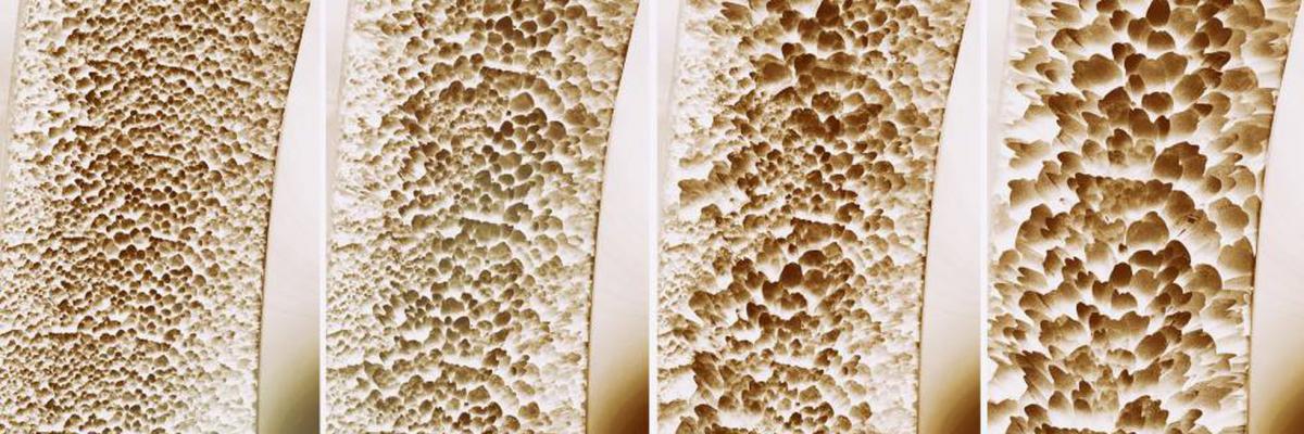 ¿Se puede curar la osteoporosis? - FisioClinics Palma