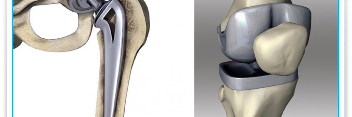 Tratamiento de fisioterapia en prótesis de cadera y rodilla