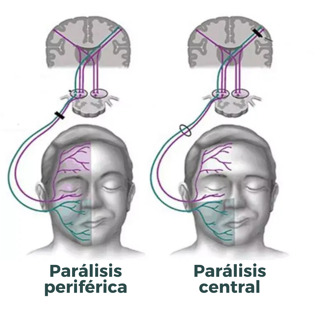 Центральный и периферический парез лицевого нерва. Центральный парез лицевого нерва поражение. Периферический парез лицевого нерва патогенез. Неврит лицевого нерва Центральный и периферический.