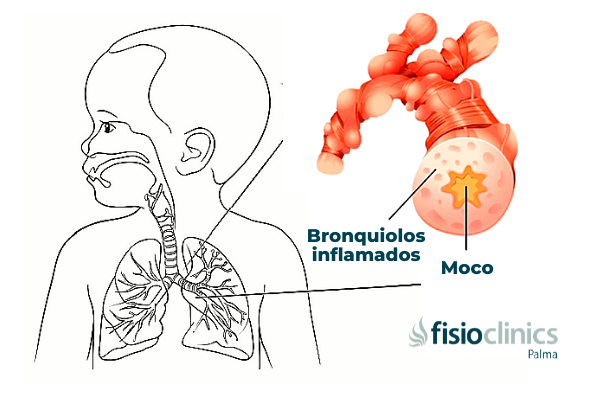 bronquiolitis bronquiolitis