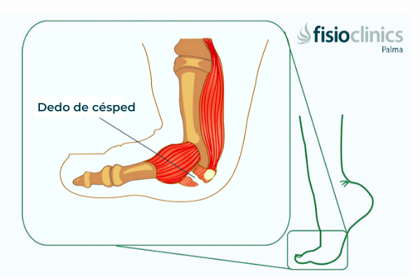 Dedo de Césped Palma Dedo de Césped Palma