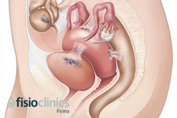 endometriosis endometriosis