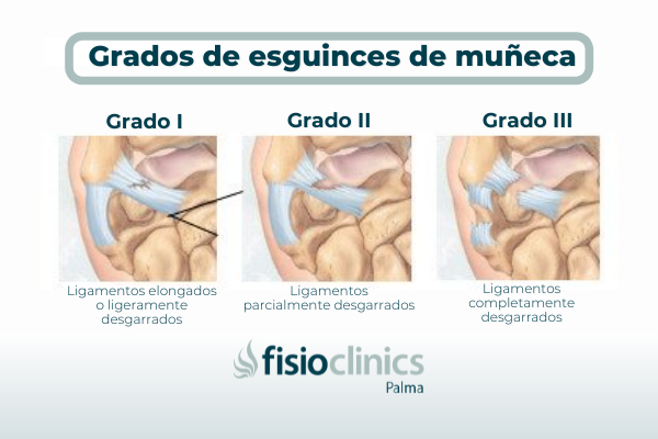 Grados de Esguinces de Muñeca Grados de Esguinces de Muñeca