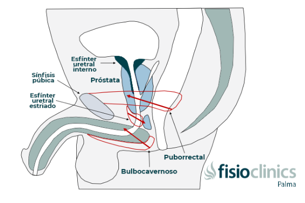 Incontinencia urinaria después de la prostatectomía Incontinencia urinaria después de la prostatectomía
