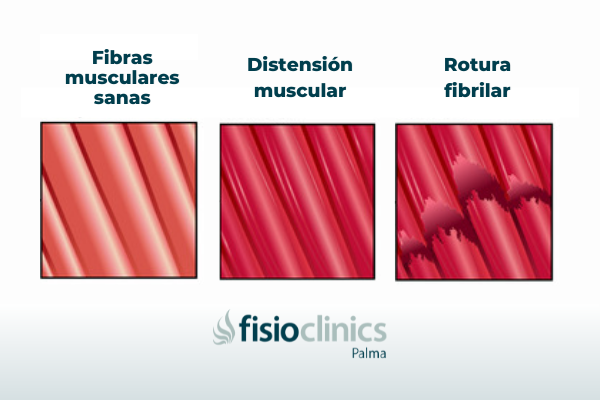 distensión rotura fibrilar palma distensión rotura fibrilar palma